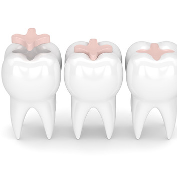 Lancaster Dental Implant Center of Salem, OR 97301 - Dental Implants, Dental Checkups, Cleaning & Examinations, Crowns, Inlays and Onlays, Bridges, Restorations, Veneers, Laminates, Bonding, Fillings, Bridge, Dentures, Partial Dentures, Teeth Whitening, Sinus Lift, Smile Makeover, Tooth Extractions, Kid Friendly Dentist, Pediatric Dentistry, Periodontics, Root Canal Therapy, Oral Cancer Screenings, Fluoride Treatments, Sedation, Root Canal Therapy, Frenectomy, Sleep Apnea Treatment, Night Guards