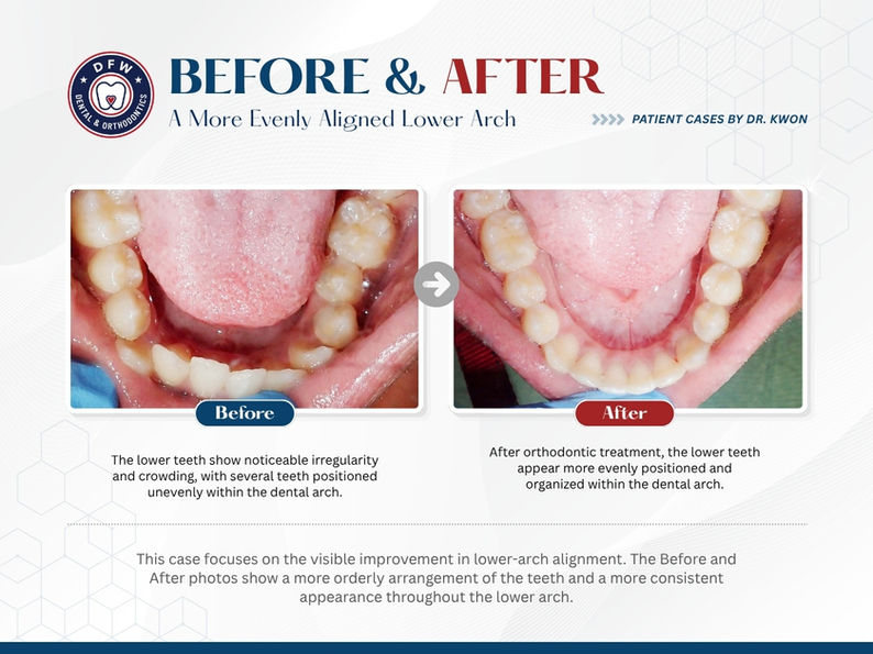 DFW Dental & Orthodontics in Irving TX 75060 - Emergency, Invisalign, Family, Cosmetic, Implants, Orthodontics - Dental Implants, Tooth Extraction, Dental Checkup, Cleaning & Examinations, Crowns, Bridges, Implants, Restorations, Veneers, Dentures, Partial Dentures, Emergency Dentist, Invisalign Dentist, Kid Friendly Dentist, Root Canal Therapy, Orthodontic Treatment, Braces
