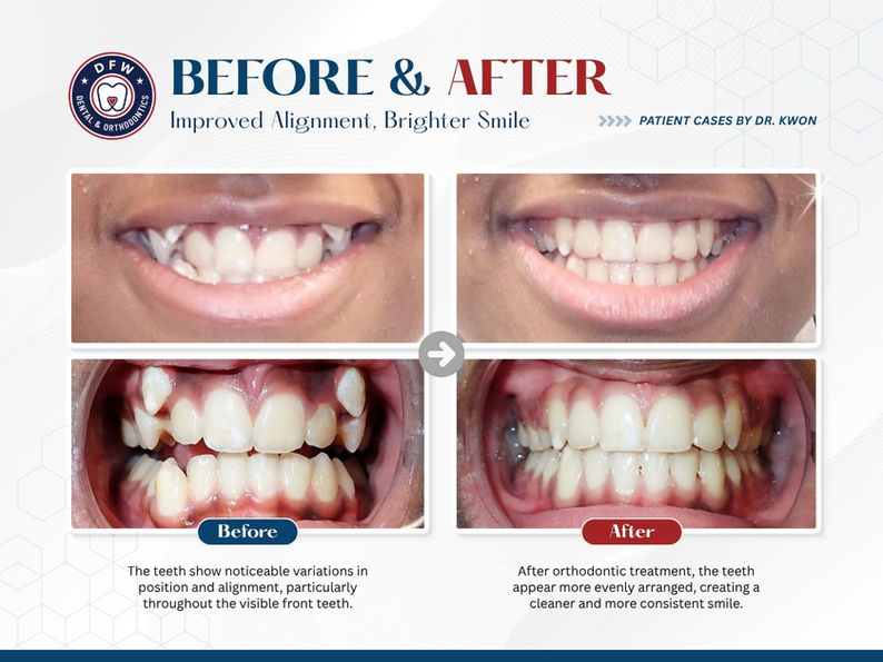 DFW Dental & Orthodontics in Irving TX 75060 - Emergency, Invisalign, Family, Cosmetic, Implants, Orthodontics - Dental Implants, Tooth Extraction, Dental Checkup, Cleaning & Examinations, Crowns, Bridges, Implants, Restorations, Veneers, Dentures, Partial Dentures, Emergency Dentist, Invisalign Dentist, Kid Friendly Dentist, Root Canal Therapy, Orthodontic Treatment, Braces