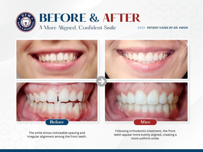 DFW Dental & Orthodontics in Irving TX 75060 - Emergency, Invisalign, Family, Cosmetic, Implants, Orthodontics - Dental Implants, Tooth Extraction, Dental Checkup, Cleaning & Examinations, Crowns, Bridges, Implants, Restorations, Veneers, Dentures, Partial Dentures, Emergency Dentist, Invisalign Dentist, Kid Friendly Dentist, Root Canal Therapy, Orthodontic Treatment, Braces