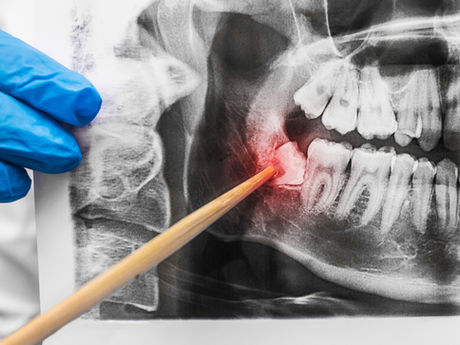 Are Your Wisdom Teeth Causing Trouble? Your Beaverton, OR General Dentist Explains