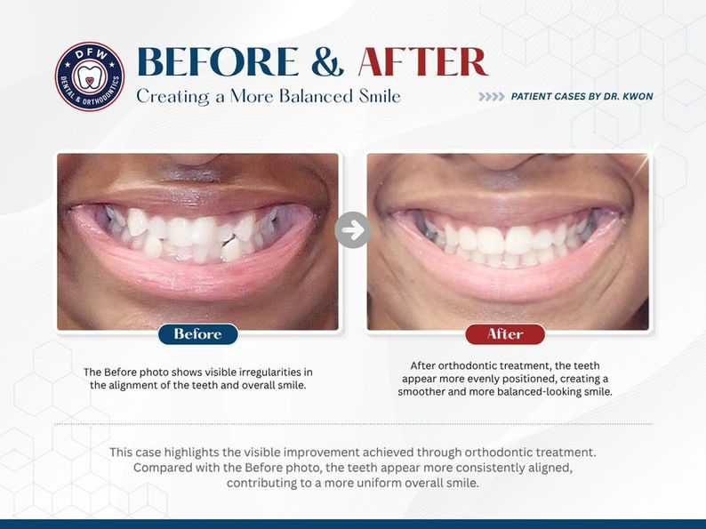 DFW Dental & Orthodontics in Irving TX 75060 - Emergency, Invisalign, Family, Cosmetic, Implants, Orthodontics - Dental Implants, Tooth Extraction, Dental Checkup, Cleaning & Examinations, Crowns, Bridges, Implants, Restorations, Veneers, Dentures, Partial Dentures, Emergency Dentist, Invisalign Dentist, Kid Friendly Dentist, Root Canal Therapy, Orthodontic Treatment, Braces