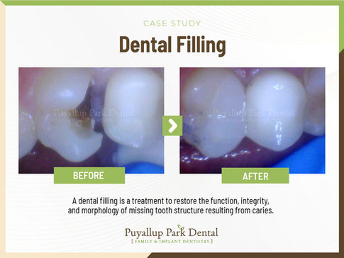 Puyallup Park Dental in Puyallup, WA 98374 Family Cosmetic Veneers Implants Invisalign Emergency Dentist - Crowns, Wisdom Teeth Extraction, IV Sedation, Kor Teeth Whitening, Tooth Bonding, Porcelain Veneers, Bridges, Fillings, Dentures, Children's Dentistry, Tooth Extractions, Exams, Cleanings, Root Canal Therapy, Dental check Up, Inlay & Onlays