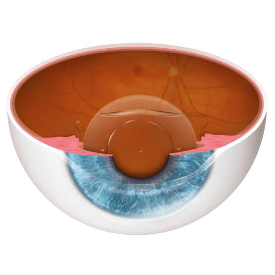 Vista de acercamiento de un modelo anatómico de ojo junto a una lente intraocular transparente.