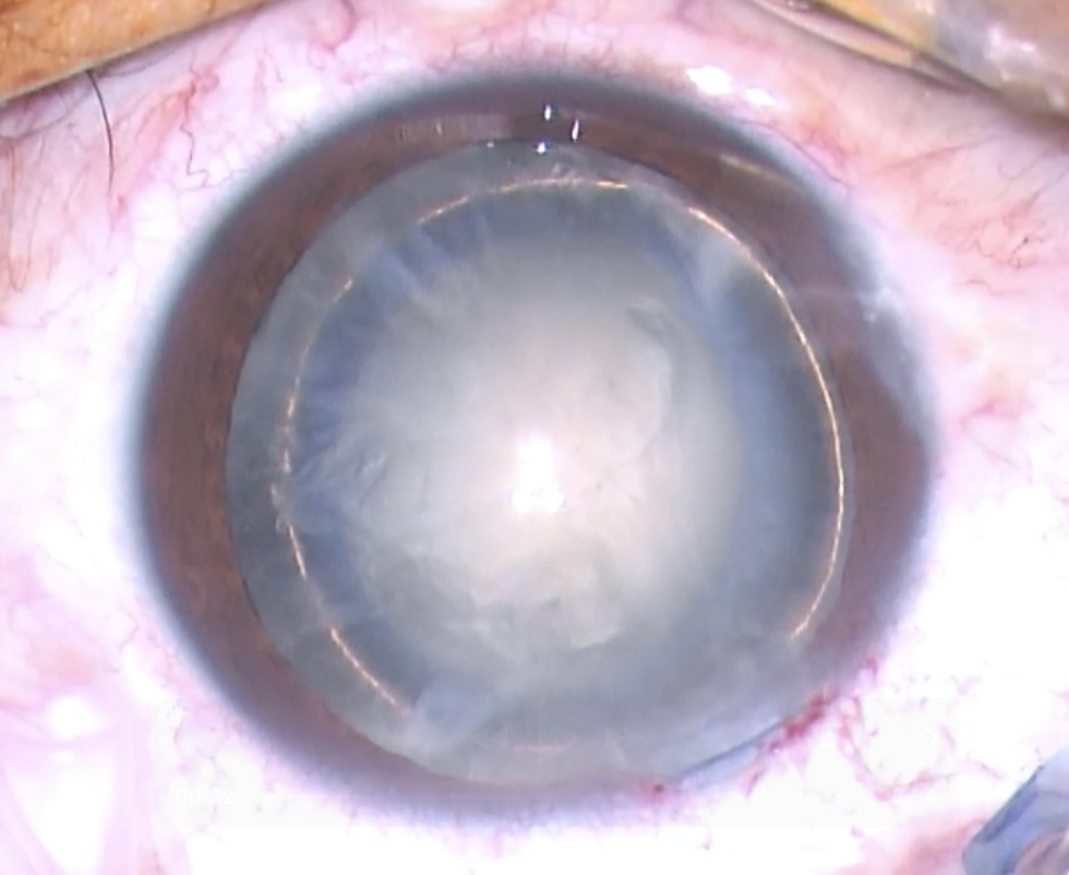 anillo dorado creado por segmentólogo durante cirugía de catarata.