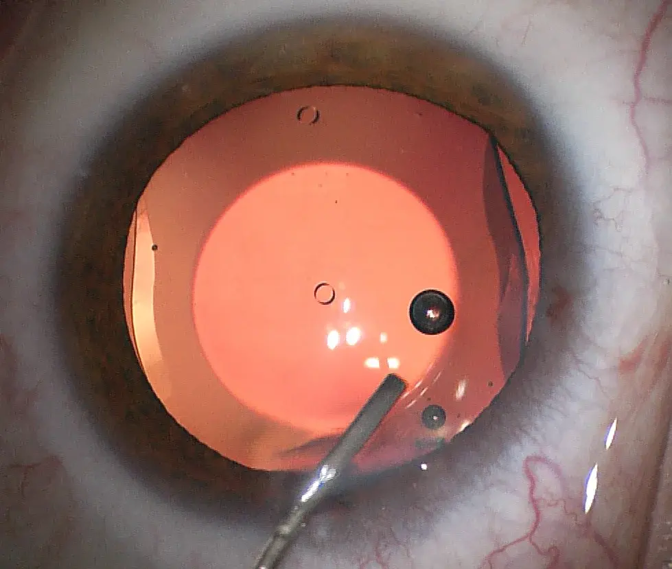 Vista lateral de una lente intraocular transparente sostenida con pinzas delicadas.