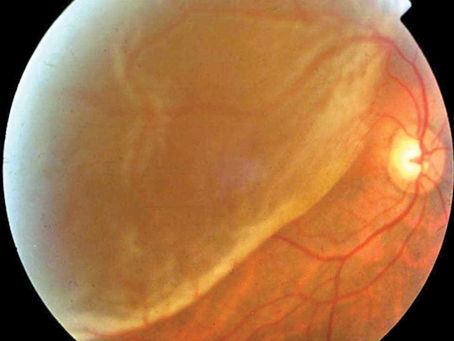 ¿Qué es un desprendimiento de retina?