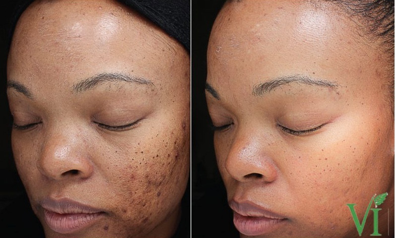 After 2 Vi Peels