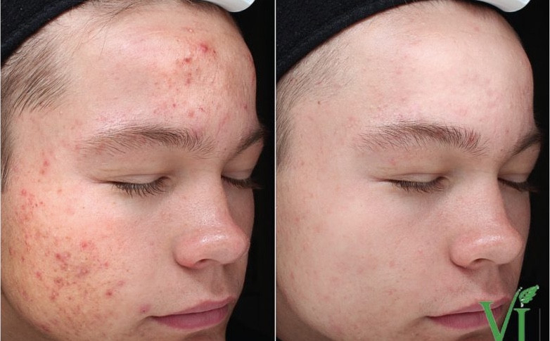 After 3 Vi Purify Peels