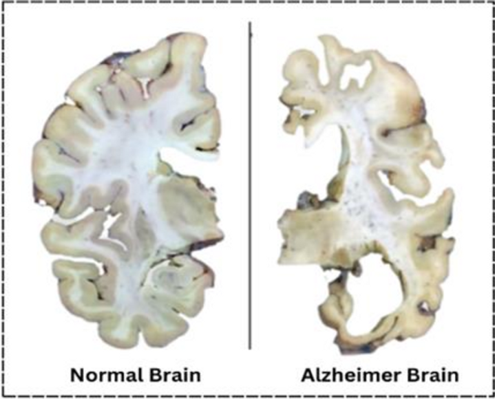 Not Normal Brain Exploring Brain Disorders