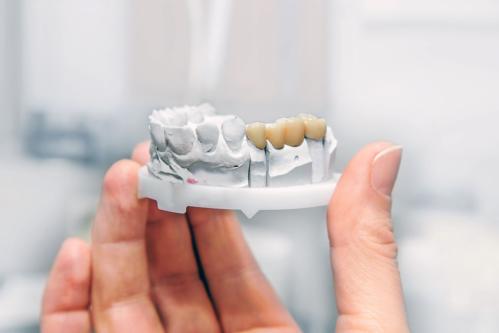 How We Custom-Make Your Dental Bridge