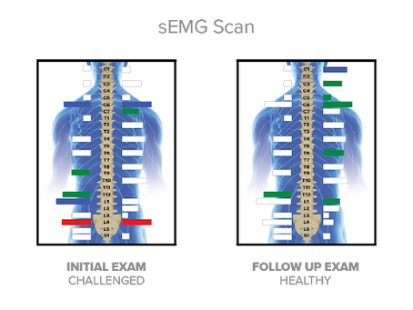 Surface Electromyography