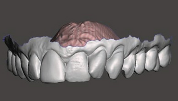 Fully Digital Workflow in the Aesthetic Zone.png