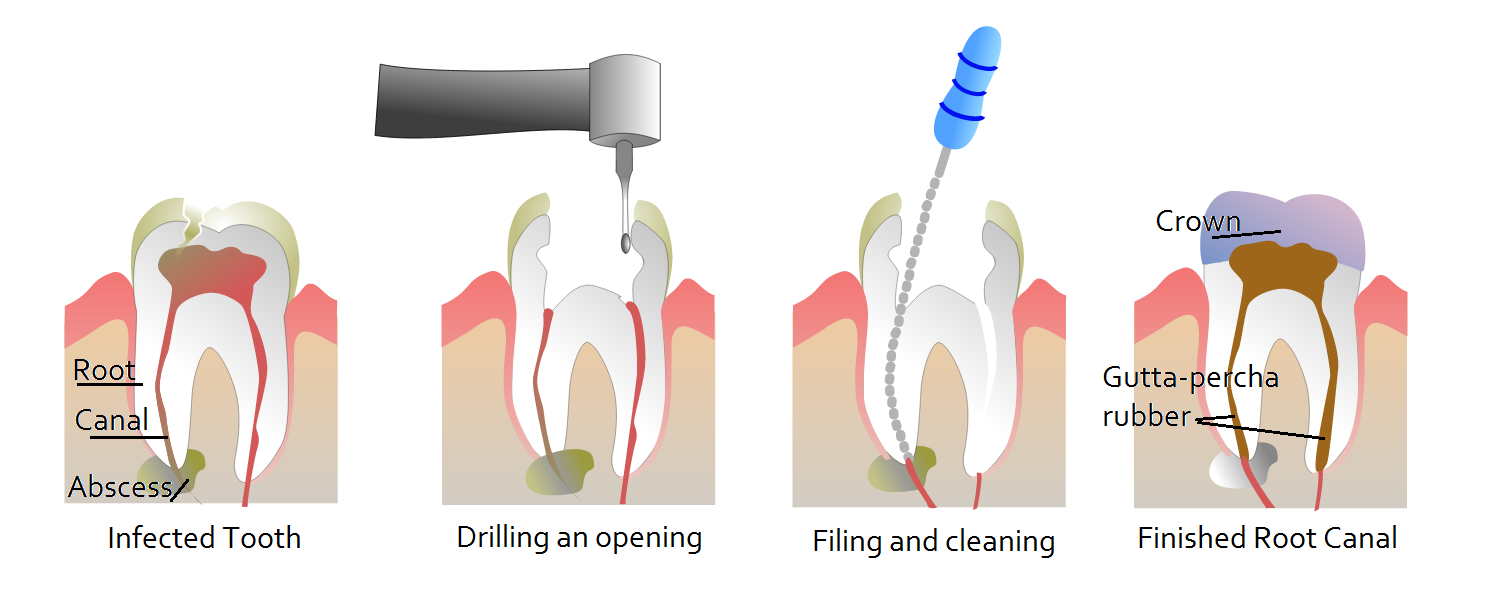 Root Canal steps