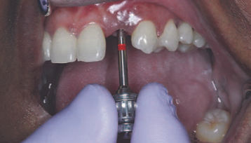 Management of a Dislodged Implant.jpg