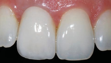 Single Implant in the Aesthetic Zone.png