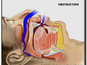 The Pathway to Restful Nights Part 1: What is Obstructive Sleep Apnea - Understanding the Health Impacts and Solutions.