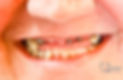 smile before