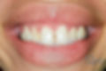 Smile before