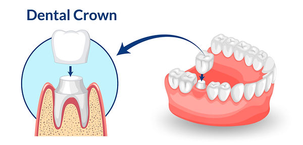 Dental crown infographic