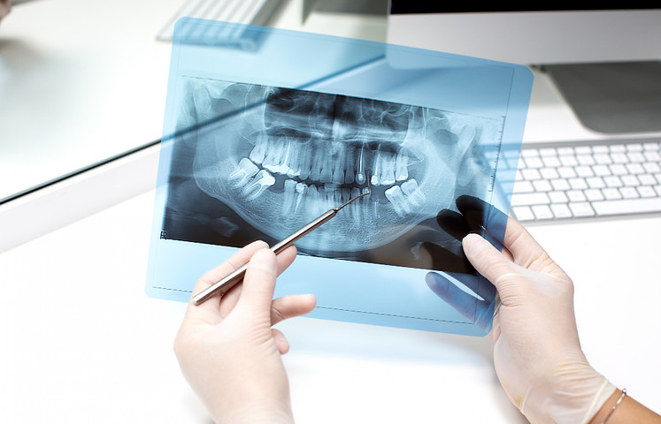 Dental x-ray image