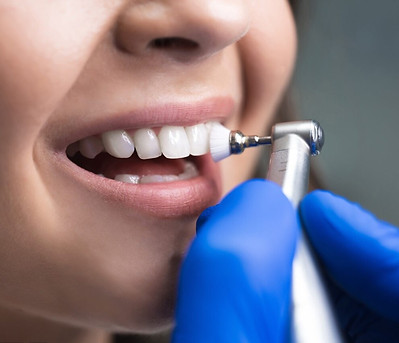 Dental cleaning at Riverview Dental Columbus