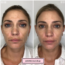 Miniaturbild: frontansicht/Portrait einer Frau vor und nach der Behandlung Intensive System™ - Correction System (3 Produkte-Set)