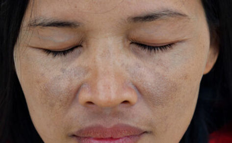 Image of a woman's face with post-inflammatory hyperpigmentation (PIH)