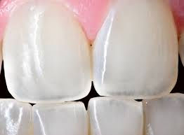 The Teeth (Specifically the Enamel) in the GNM: When you are not allowed to bite back
