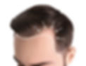 Hair-Loss-Patterns-1024x800.jpeg