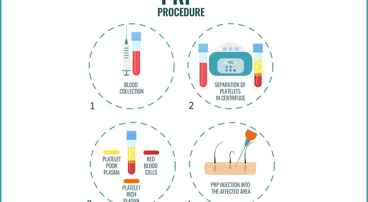 Should You Find PRP Cost for Skin and Hair Treatments?