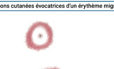 erythème tique_edited.jpg