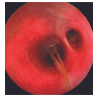Veterinarian removed foxtail from bronchus.