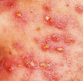 acne - pustules.jpg