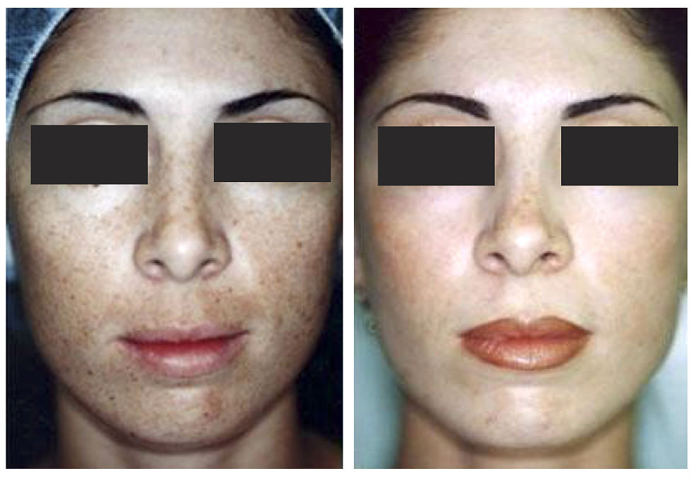 Chemical Peel