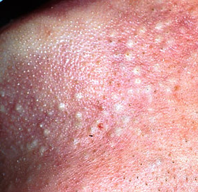 acne - papules.jpg