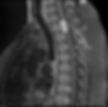 Meningioma coluna