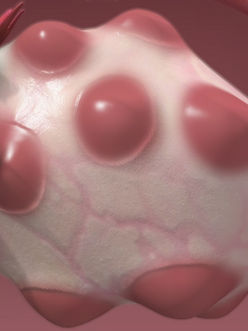 Polycystic ovarian disease (PCOS) and everything about it