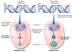 Pompe Syndrome