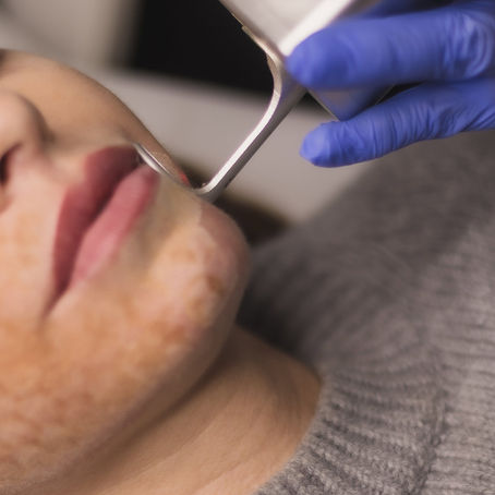 CO2 Vs. Erbio Fraccional para Rejuvenecimiento Facial