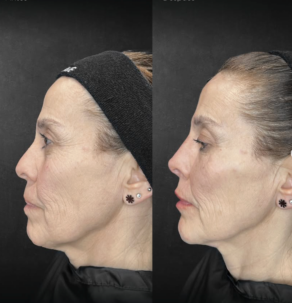 ArmonizaciónTercio Medio Rostro