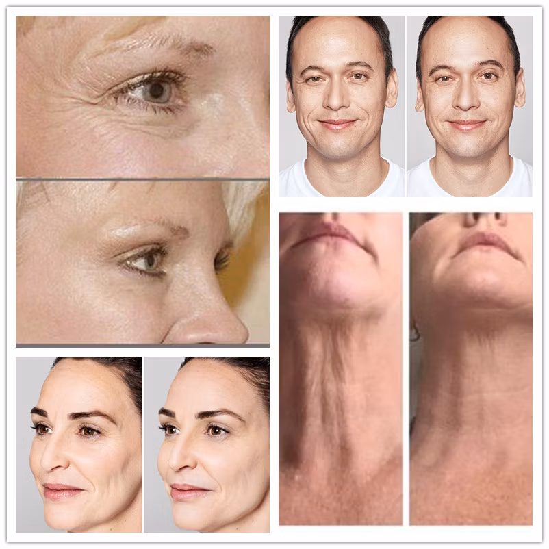 Mesoterapia c/Potenciadores de Colágeno