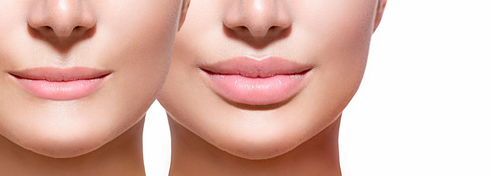 Aumento de labios