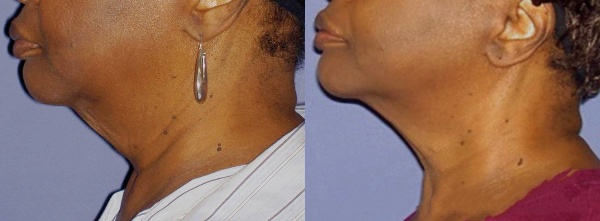 Forma Skin Tightening Treatment Before and After 6