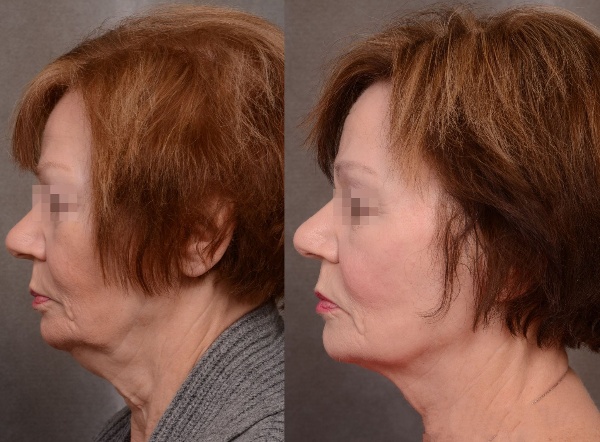 Forma Skin Tightening Treatment Before and After 1