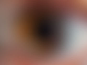 Close up of an eye showing signs of meibomian gland dysfunction along the lid margin