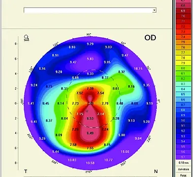 Corneal-topography-in-a-keratoconus-eye.png.webp