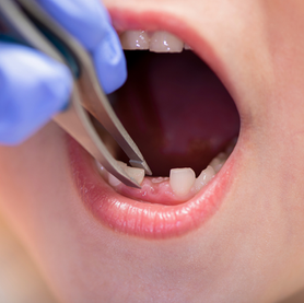 Close-up of a chipped front tooth, highlighting the risk of dental injury in contact sports.