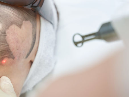 Unlocking Clear Skin: How Pico Laser Treatment Can Help Men Banish Dark Spots