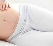 Signs Your C- Section Is Healing Properly